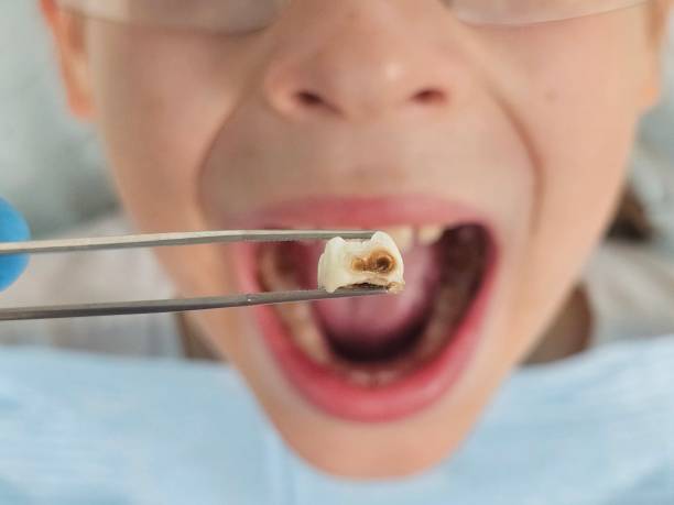 Best Dentist for Tooth Abscess  in Lancaster, WI